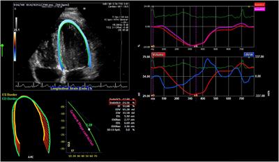 Cardiovascular health in pediatric patients with X-linked hypophosphatemia under two years of burosumab therapy